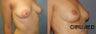 Breast Lift