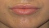 Mild asymmetry in upper lip volume