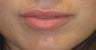 Mild asymmetry in upper lip volume