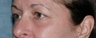 Fraxel Repair Treatment Around Eyes