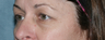 Fraxel Repair Treatment Around Eyes
