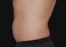 CoolSculpting