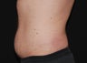 CoolSculpting