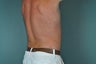 Liposuction