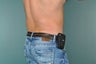 Liposuction