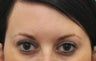Botox for treatment of upper face wrinkles