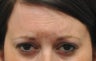 Botox for treatment of upper face wrinkles