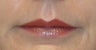 58 Year Old Patient Treated with Juvederm