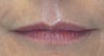 58 Year Old Patient Treated with Juvederm
