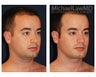 Liposuction