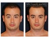 Liposuction