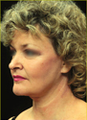 Face and Neck Lift
