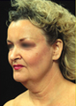 Face and Neck Lift