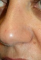 Mole Removal