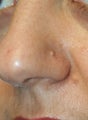 Mole Removal