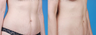 Mini Tummy Tuck