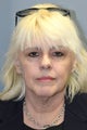 LiteLift™ and Platysmaplasty on 60-year-old Female