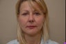 48 year old female seeking surgery for lower face skin laxity and jowls