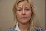 48 year old female seeking surgery for lower face skin laxity and jowls