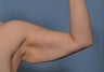 45 Year Old With Saggy Upper Arms