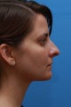 Isolated Necklift