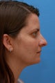 Isolated Necklift