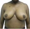3 Month Post Operative Breast Reduction