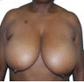 3 Month Post Operative Breast Reduction