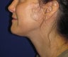 Neck Liposuction