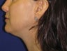 Neck Liposuction