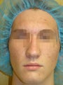 Acleara acne treatment with microextraction device