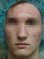 Acleara acne treatment with microextraction device