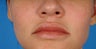37 year old female who desired more full and defined, but natural lips.