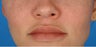 37 year old female who desired more full and defined, but natural lips.