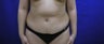 Tummy Tuck