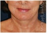 Facelift