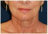 Facelift