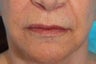 Female Upper Lip Reduction