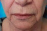Female Upper Lip Reduction