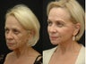 Facelift