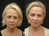 Facelift
