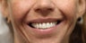 26 year old female treated with All-on-4 Dental Implant Procedure
