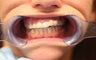 26 year old female treated with All-on-4 Dental Implant Procedure