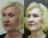 64 year old female treated for sagging and devolumized face