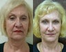 64 year old female treated for sagging and devolumized face