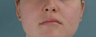 Microfat Lip Injections