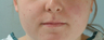 Microfat Lip Injections