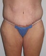 42 Year Old Woman with Tummy Tuck and Body Lift