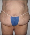 42 Year Old Woman with Tummy Tuck and Body Lift
