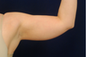 Liposuction of the Upper Arms